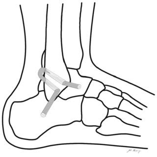 Anatomical reconstruction of anterior talofibular ligament. Figure 8 ...