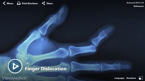 Video: Finger Dislocation - Hughston Clinic