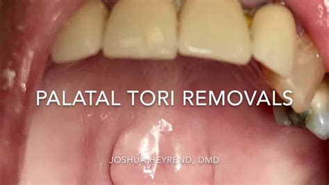 Palatal Tori Removals - YouTube