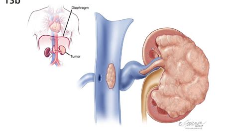 Decoding Kidney Cancer and Kidney Cysts: Unveiling Their Differences