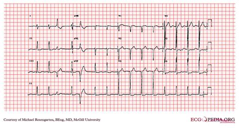 McGill Case 197 - ECGpedia