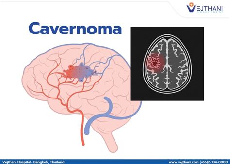 What is a Cavernous Hemangioma?