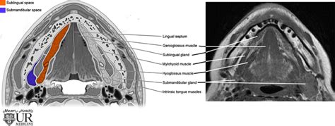 Imaging of the sublingual and submandibular spaces | SpringerLink