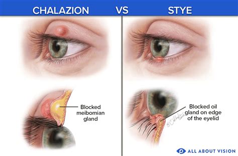 Chalazion & Styes - Lutz, FL: Sara Creekmore, D.O.: Ophthalmologist ...