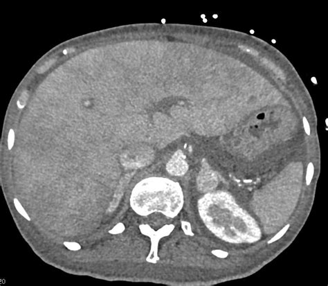 Budd Chiari Syndrome - Liver Case Studies - CTisus CT Scanning