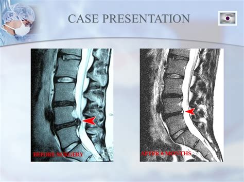 Dr. Luis Lombardi-L4/L5 Herniated Disc - Doctor Luis Lombardi