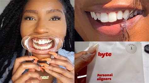 Fixing my TEETH!! Affordable Aligners to Straighten Teeth| My Byte Journey | iamLindaElaine ...