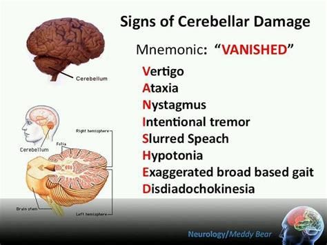 There are several mnemonics on memorizing signs of Cerebellar Damage. Here's one out of the ...