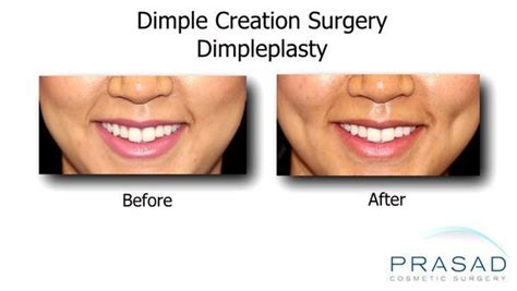 Dimple Surgery Before And After | Renew Physical Therapy