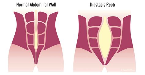 Diastasis Recti Pregnancy Also Known Diastasis Rectus Abdominus ...