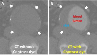 AI to replace contrast dye injections in CT heart scans | Total Health