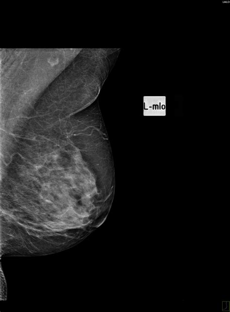 Invasive Lobular Carcinoma