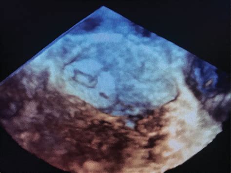 Thrombus on the device early after the procedure of the left atrial appendage closure with the ...