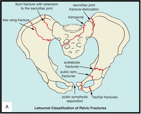 Superior Pubic Ramus Fracture