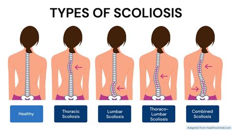 Is Scoliosis Genetic? - Xcode Life