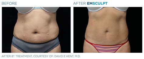 Emsculpt Before and After | Real Patient Results