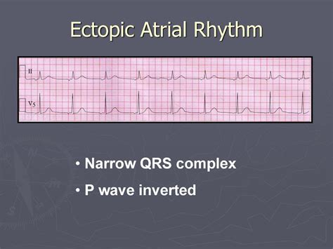 Basics of EKG Interpretation - презентация онлайн