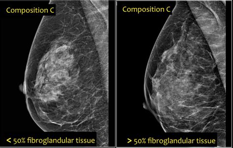 Mammography Bi Rads Chart