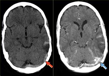 Transverse Sinus Mri