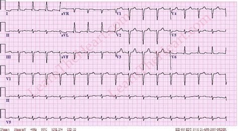 EKG JEOPARDY ! Jeopardy Template