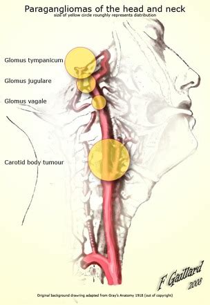 Vagal paraganglioma | Radiology Reference Article | Radiopaedia.org