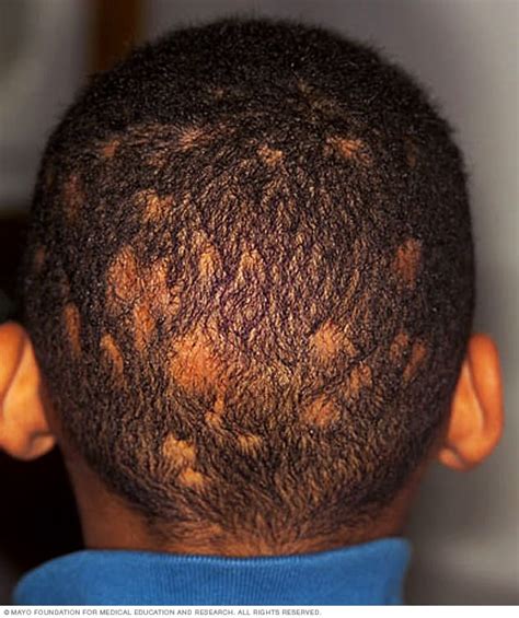 Ringworm Scalp Symptoms And Causes Mayo Clinic | My XXX Hot Girl