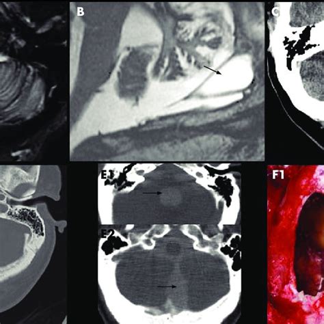 A T2 weighted axial head MRI shows haemosiderin deposition along the... | Download Scientific ...