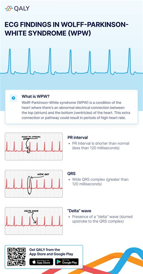 What Wolff-Parkinson-White Syndrome (WPW) Looks Like on Your Watch ECG | Qaly