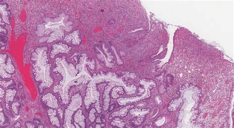 Inflammatory type polyp of the colon | Atlas of Pathology