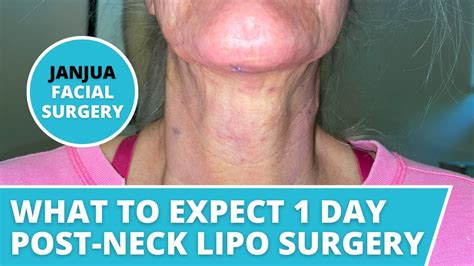 NECK LIPOSUCTION RECOVERY (ONE DAY POST OP) - DR. TANVEER JANJUA - NEW ...