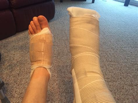 Before, During, & After Bunion Surgery...: Bunion Surgery and Hardware Removal ~ Second Foot ...