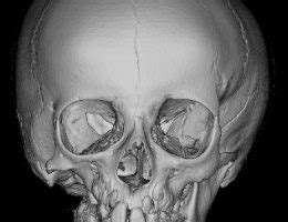 Mandible (jaw) Deformities | Dr. Bastidas Craniofacial and Plastic Surgeon