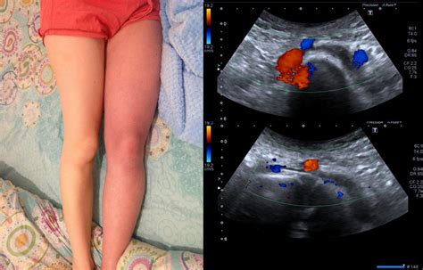 May Thurner Syndrome. Clinical and ultrasonographic features ...