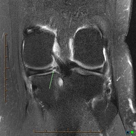 Meniscal Root Tear Mri