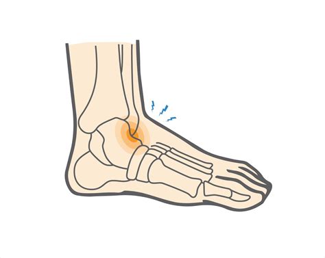 What is an Anterior Ankle Impingement & How is It Managed? - Upswing Health