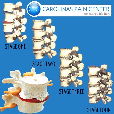 Degenerative Disc Disease - Carolinas Pain Center