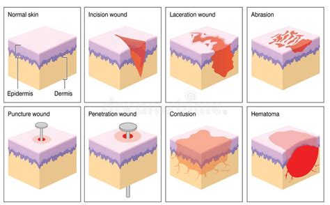 Skin wounds stock illustration. Illustration of hematoma - 74056337