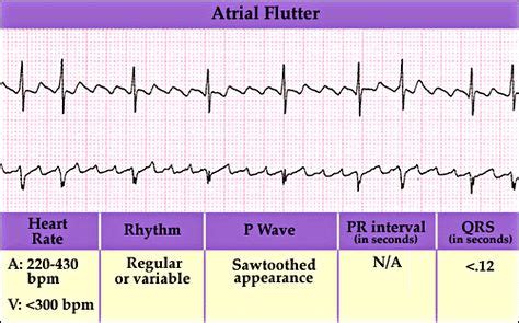 Atrial-flutter-ECG.gif (500×312) | Atrial flutter, Flutter, Nursing school tips