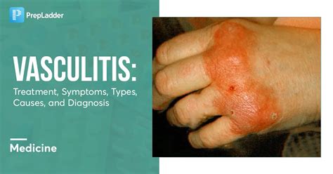 Vasculitis: Treatment, Symptoms, Types, Causes, & Diagnosis