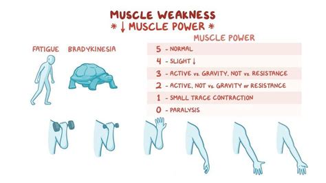 Muscle weakness: Clinical: Video, Anatomy & Definition | Osmosis