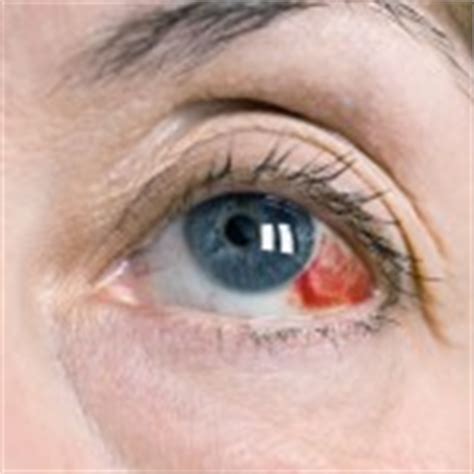 Broken capillaries in eyes: Causes and remedies - From Doctor