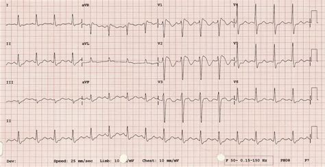 What is Brugada Syndrome? • LITFL