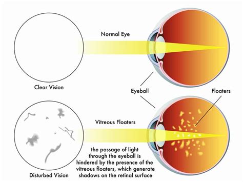 When To Be Concerned with Eye Floaters - Eye Clinic of Florida