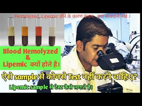 Lipemic serum and causes|Hemolysis sample and causes|Hemolyzed & Lipemic sample| - YouTube