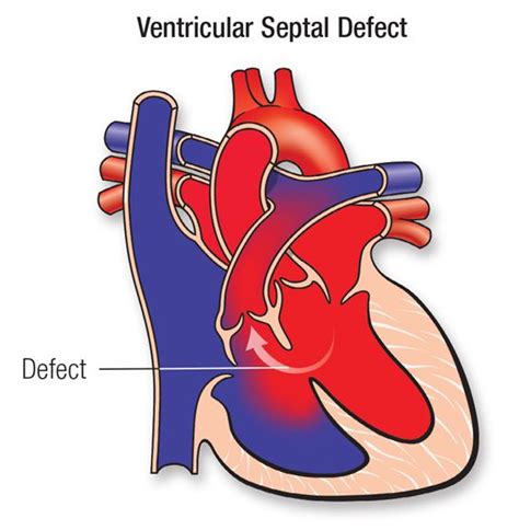 Ventricular Septal Defect (VSD) | American Heart Association | Comunicación interventricular ...