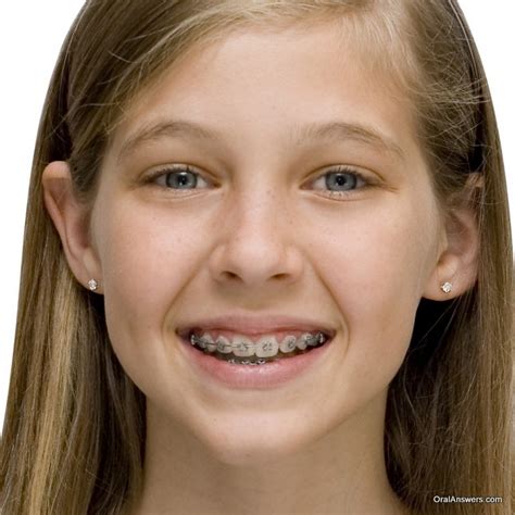 60 Photos of Teenagers with Braces - Robweigner's blog