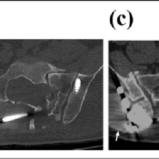 (a) Radiograph at the time of the injury shows left sacral fracture... | Download Scientific Diagram