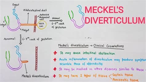 Meckel's Diverticulum With Clinical Correlations - YouTube