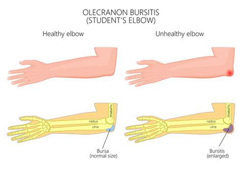 Olecranon Bursitis Elbow Pad