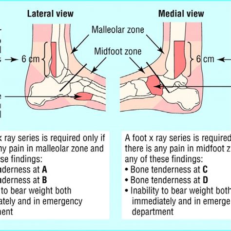 Ottawa Ankle Rules 47 | Download Scientific Diagram